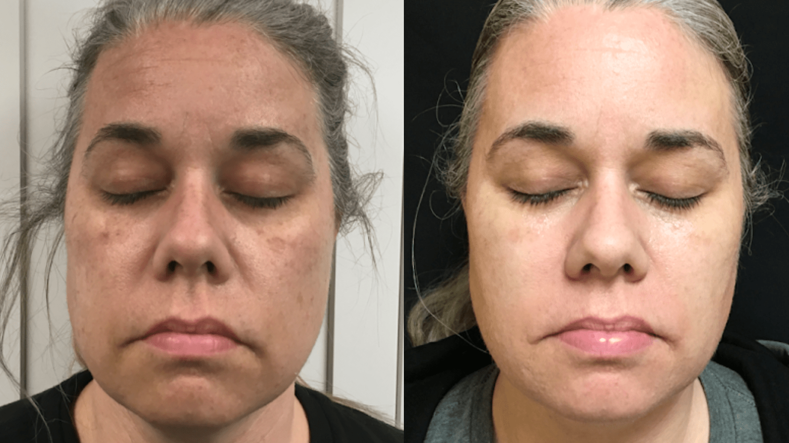 3 txs
3.5 months
This patient had enjoyed years of working with horses outdoors. 3 sessions of pico genesis lightened up many of the solar lentigines she earned over the years. Although recommended, this patient does not use maintenance skin care.