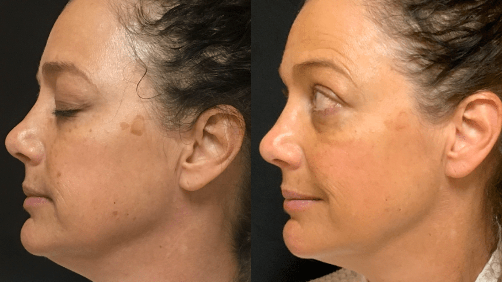 Pico Genesis and spot tx. 
4tx
This patient works outside. 4 months during late winter and spring, wearing full sunscreen. Will continue to treat to further reduce size and density of solar lentigines.