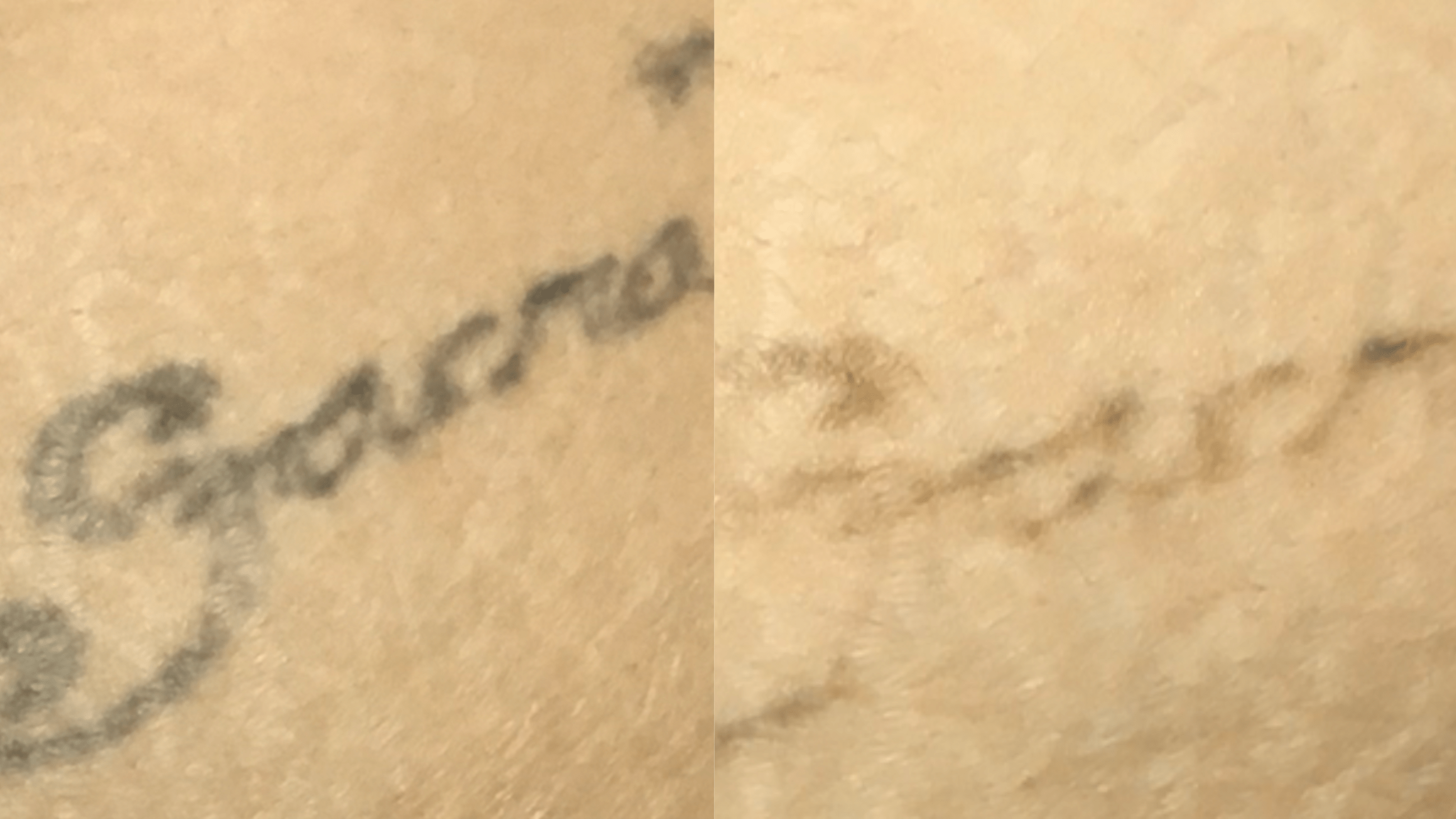 1 tx - 2 months - 28yr old, amateur tattoo on lower abdomen.