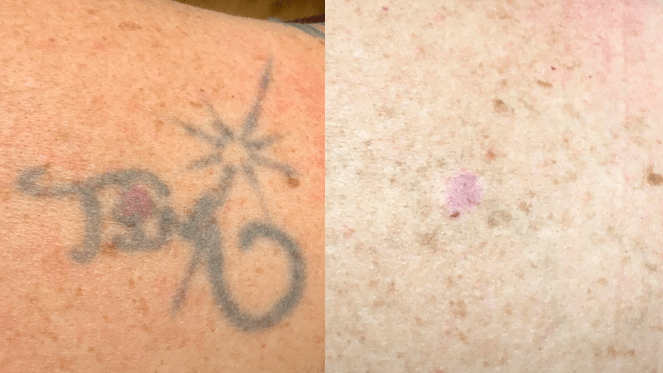 4 tx - 10.5 months - Located on the back of the shoulder, the black ink in this tattoo was shallow and aged, allowing for a relatively quick removal in just 4 sessions.