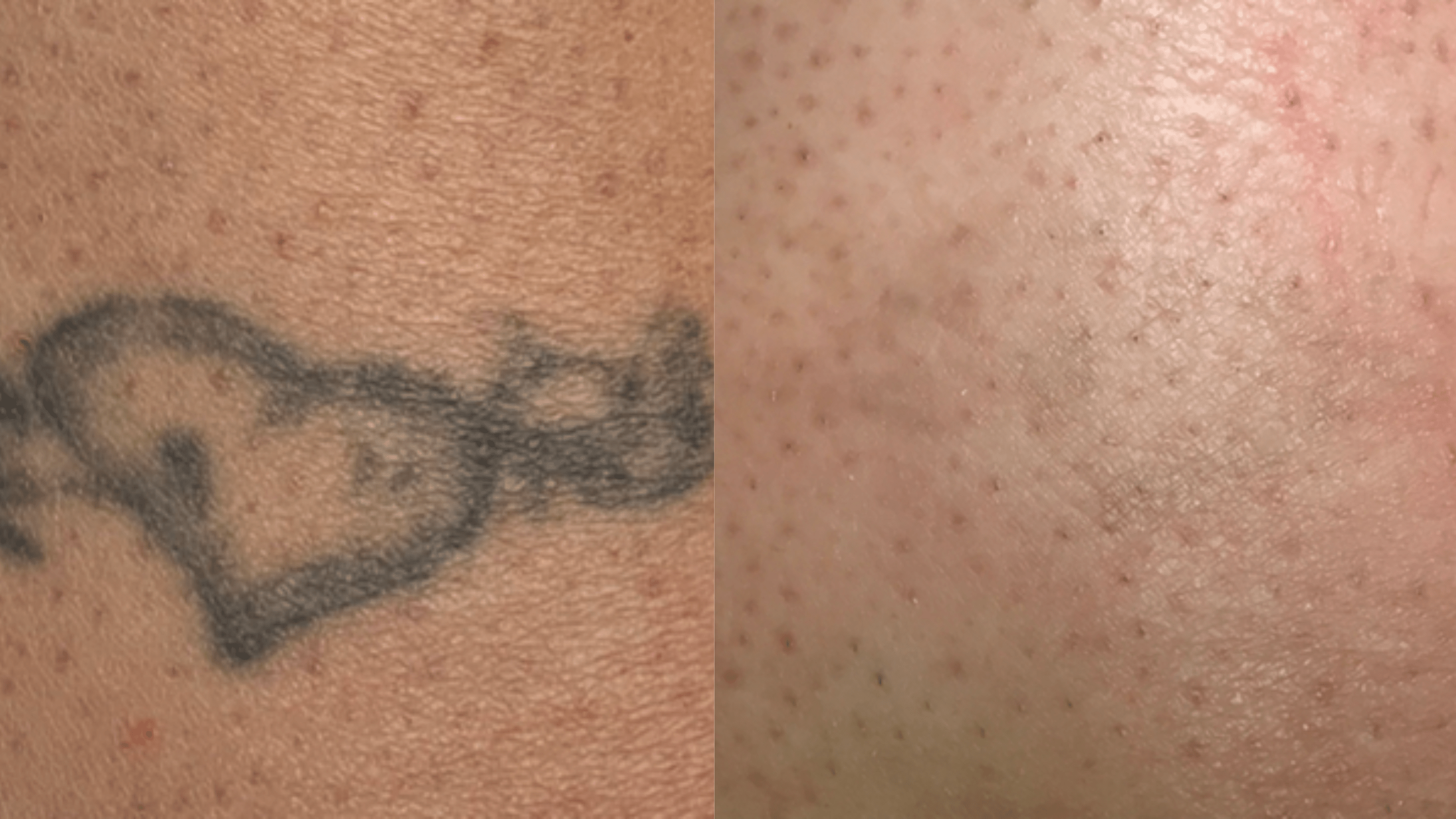 7 tx - 16 months - Located on the inner ankle, the black in this tattoo was also shallow and aged. However, compared to the circulation in the upper back, there is less circulation in the lower leg. This is a good example of how location affects the rate of ink reduction over time. The further away from the heart a tattoo is located, the more time it will likely need to diminish.