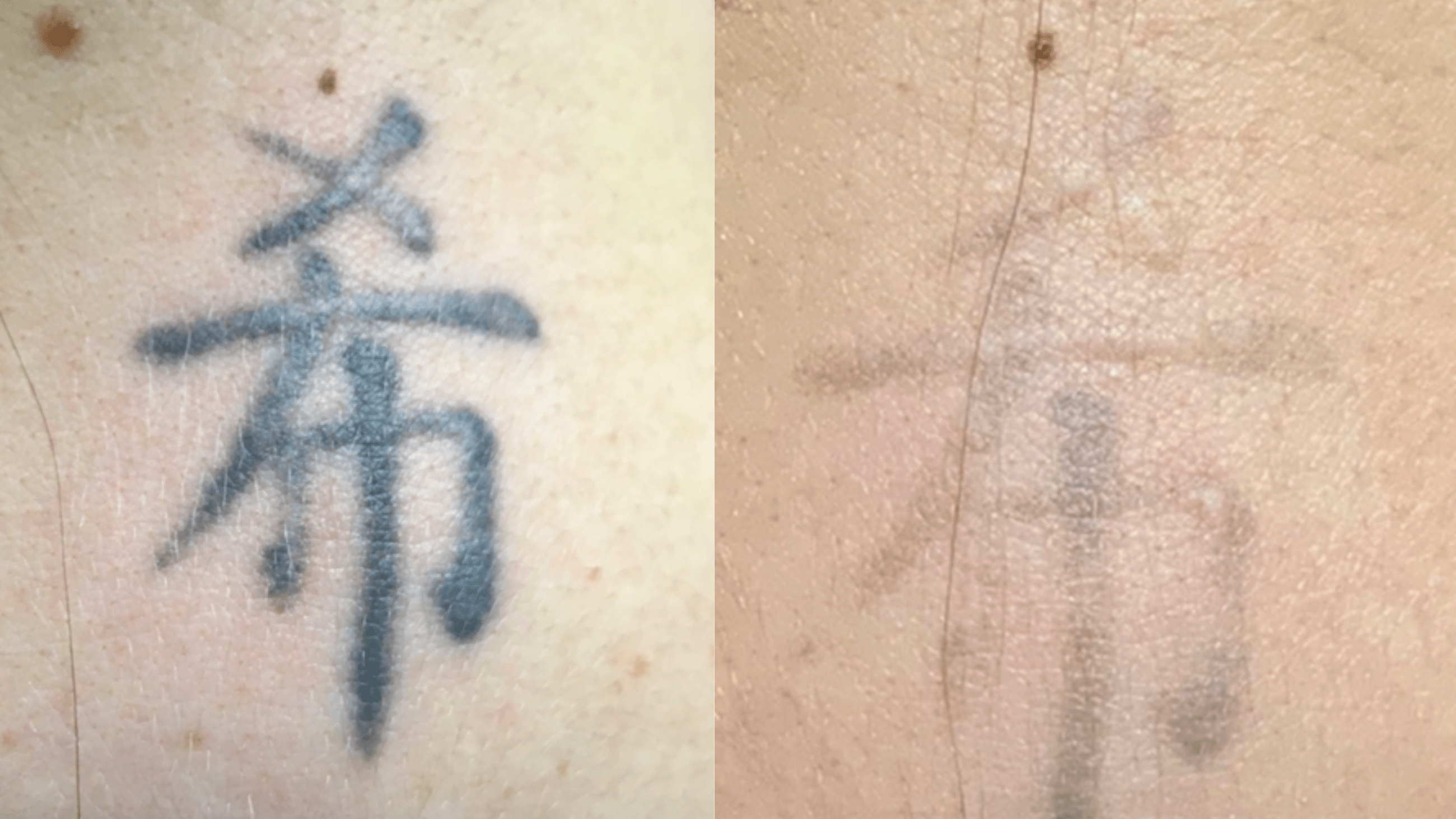 7tx - 13 months - Black Japanese Symbol on back of neck. Elevated scar present prior to tx. This tattoo will likely be fully removable. However, the initial scar will be left behind even after the ink is gone.