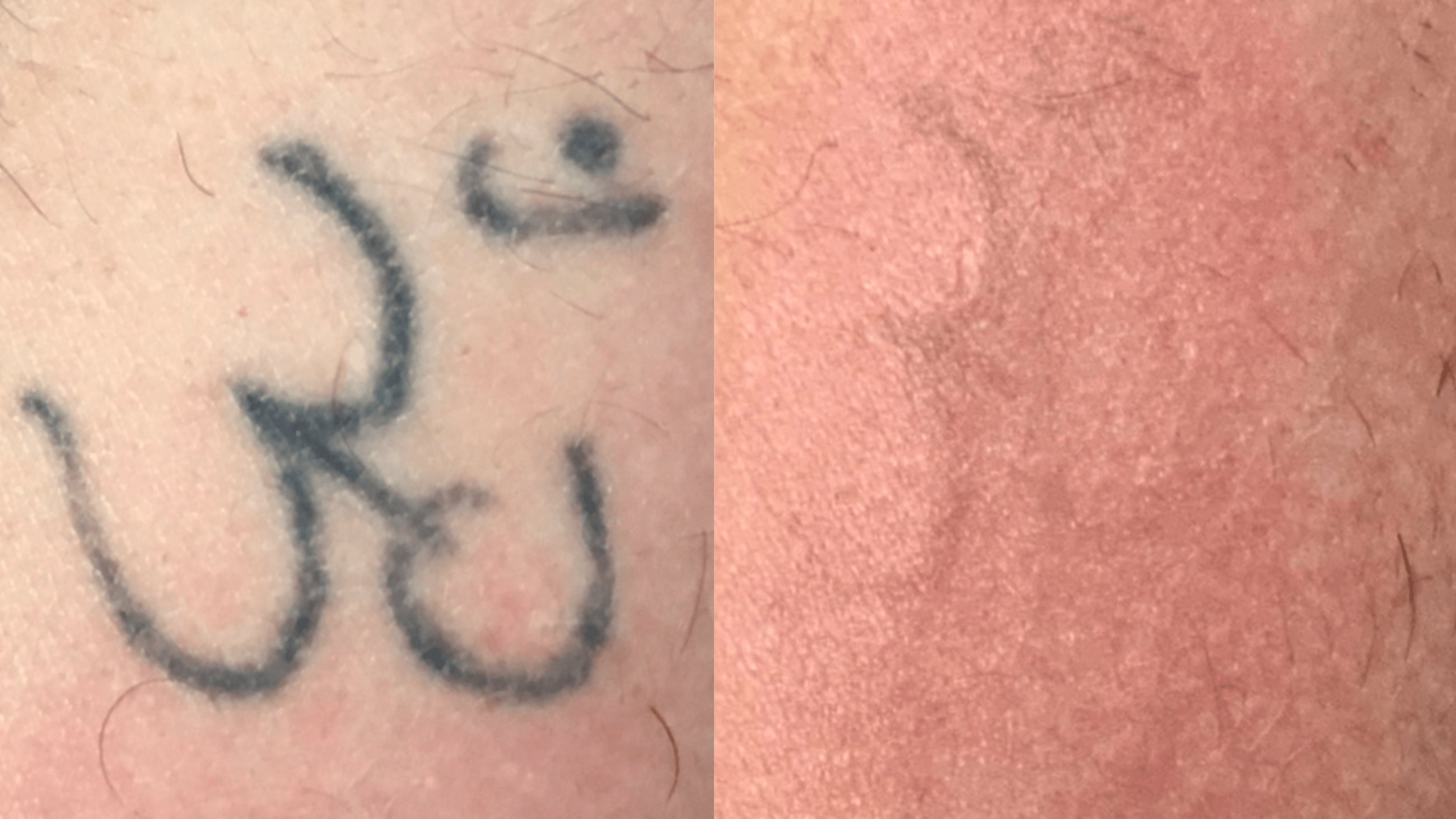6 tx - 12 months - Tattoos on the neck generally diminish quicker than on other areas.