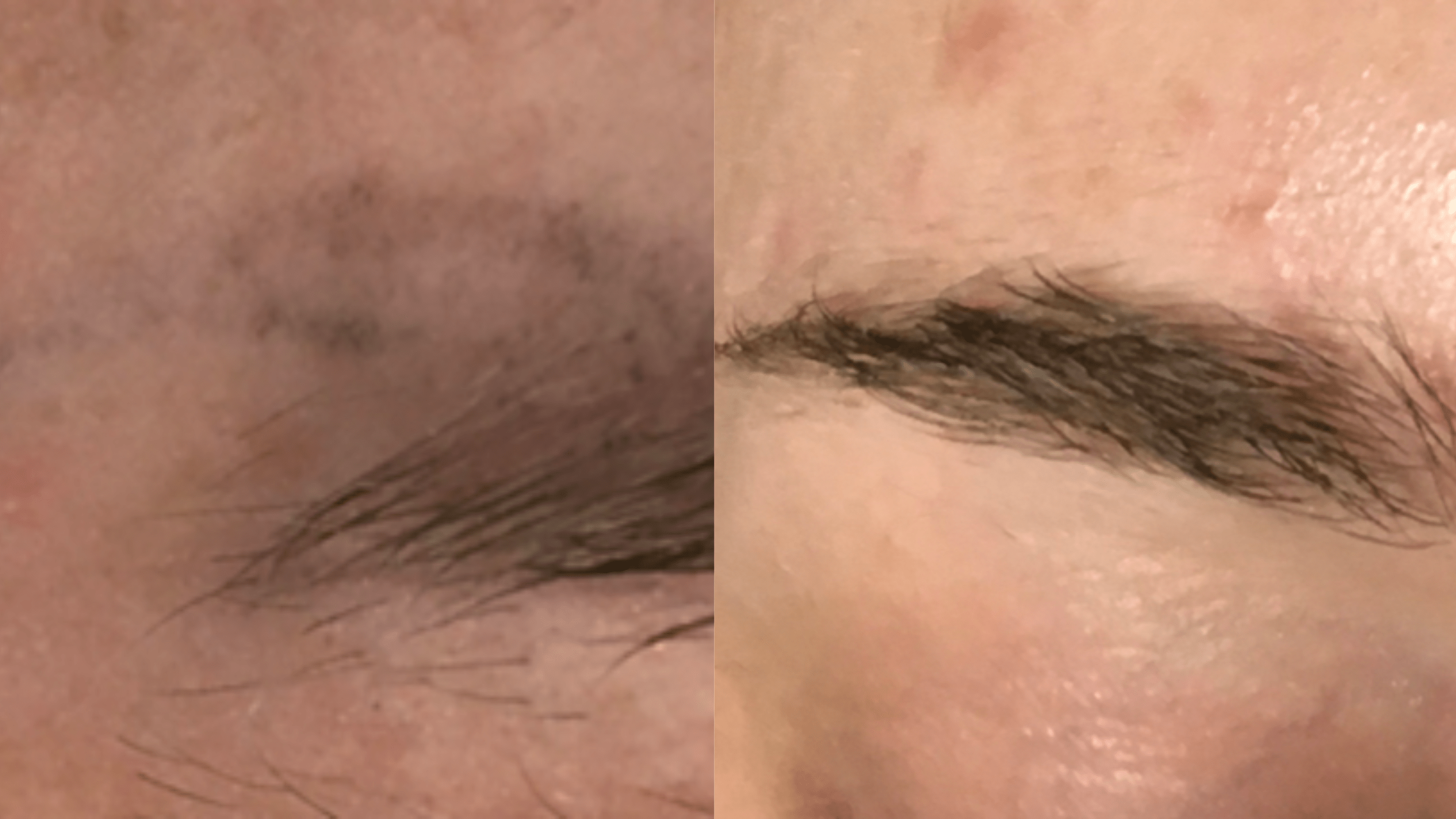 3tx - 5 months - This patient had tried everything to remove her oddly shaped microbladed brows. Including multiple glycolic peels and saline solution removal attempts. Nothing cleared the ink. In just 3 easy Enlighten txs she is now enjoying her natural brows.