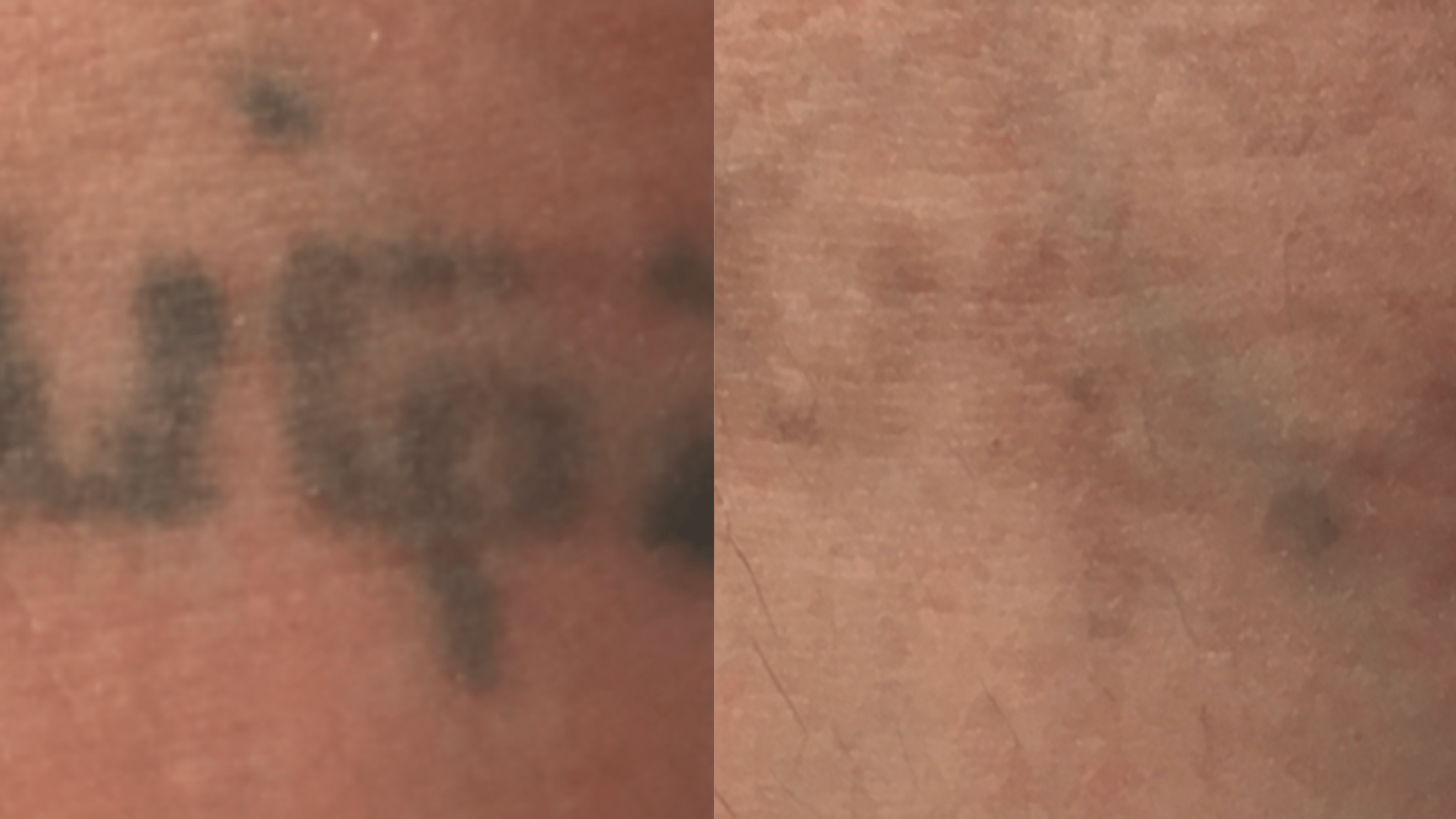1 tx - 4 months - R Inner forearm. Aged, amateur tattoo. Ink was more dense, so the first treatment did not fully remove, however it was so light the patient was very happy with the result and declined further treatment.