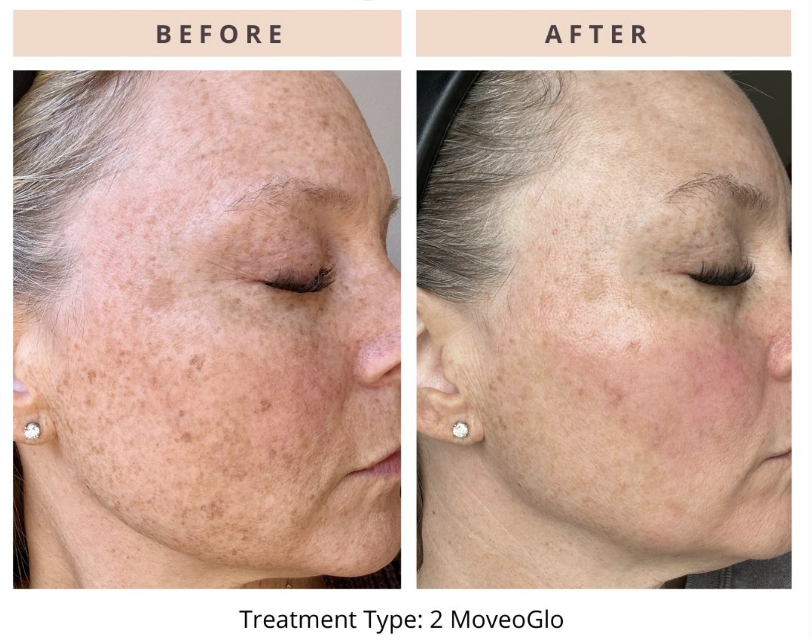 Premier Body and Laser - Motus AZ+ Laser - Before & After Photos - 3