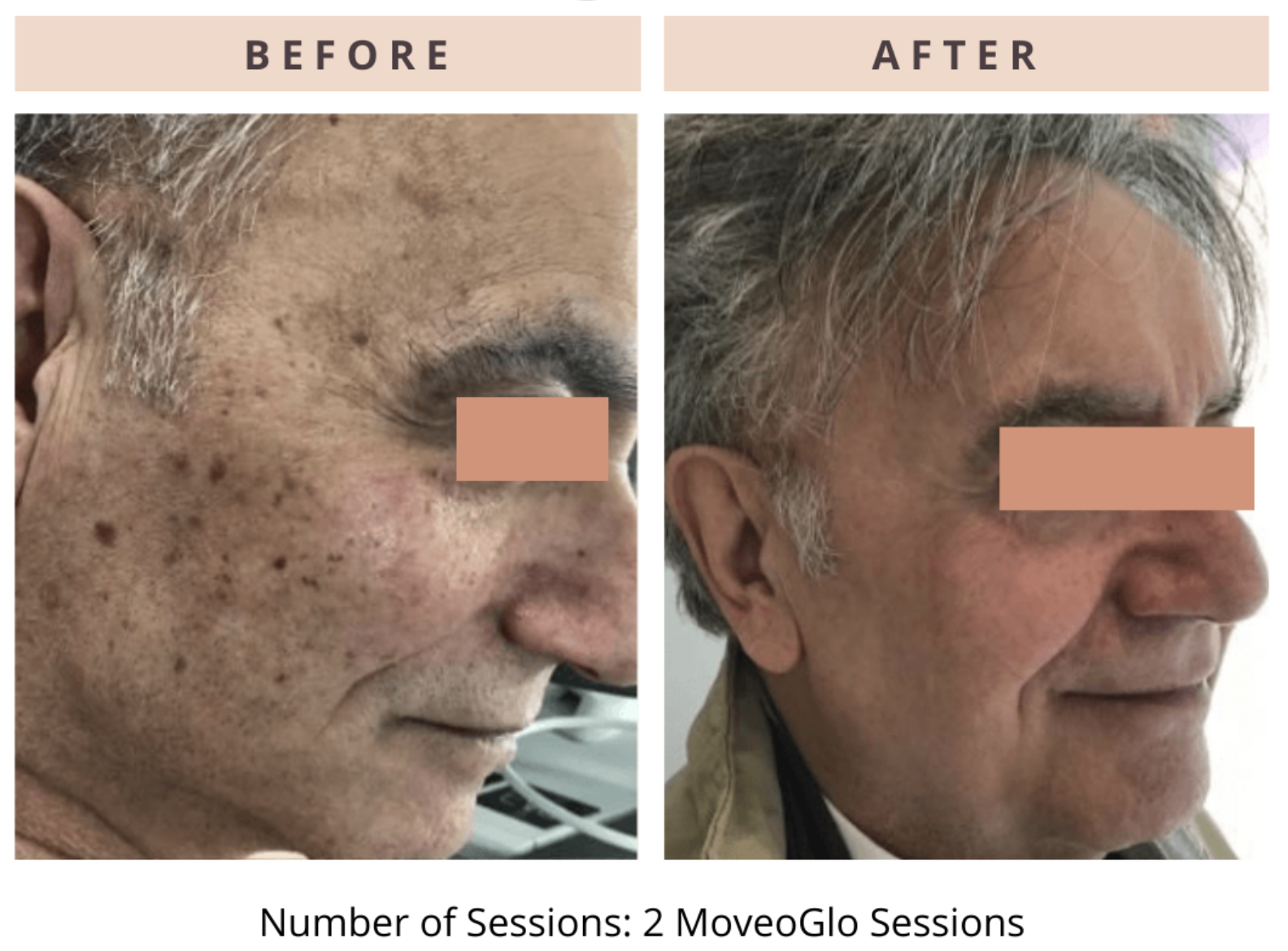 Premier Body and Laser - Motus AZ+ Laser - Before & After Photos - 4